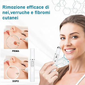 Penna per la rimozione di verruche e nei per la cura del corpo