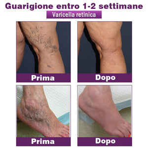 Cerotti per il corpo (per vene varicose, capillari e gonfiore alle gambe)