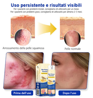 Spray per la psoriasi al veleno d'api