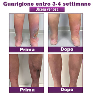 Cerotti per il corpo (per vene varicose, capillari e gonfiore alle gambe)