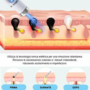 Penna per la rimozione di verruche e nei per la cura del corpo