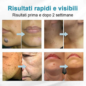 Penna per la rimozione di verruche e nei per la cura del corpo