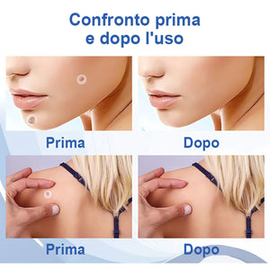 Cerotti per la rimozione di verruche e nei (acquista 1 e ricevine 1 gratis)