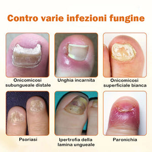 Spray riparatore avanzato per unghie