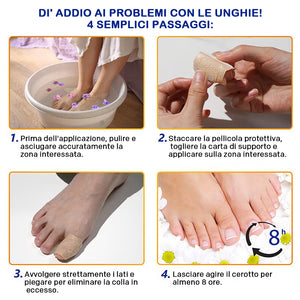 micosi alle unghie