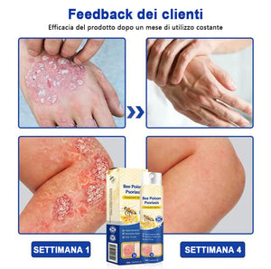 Spray per la psoriasi al veleno d'api